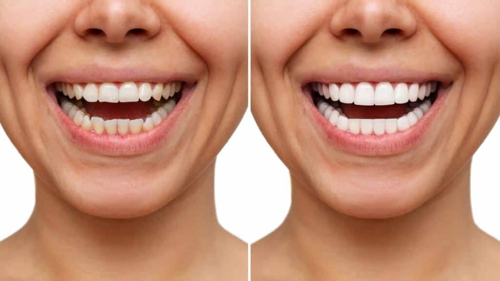 Contact Aspire White for teeth whitening services – Get in touch with Burton upon Trent today