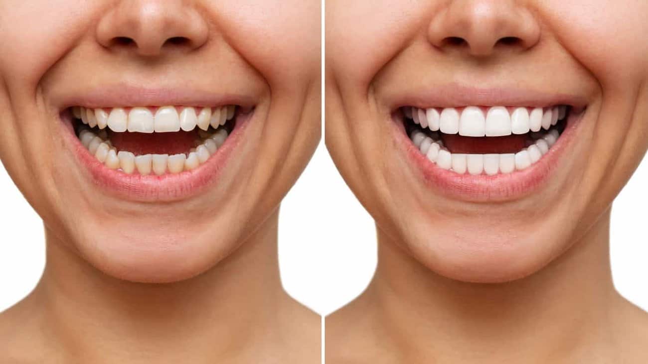 Contact Aspire White for teeth whitening services – Get in touch with Burton upon Trent today