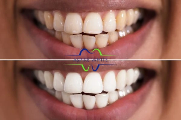 Aspire White customer before and after Burton upon Trent results.