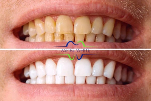 Get noticeable whiter smile in just one hour! Book your teeth whitening treatment Burton upon Trent today!
