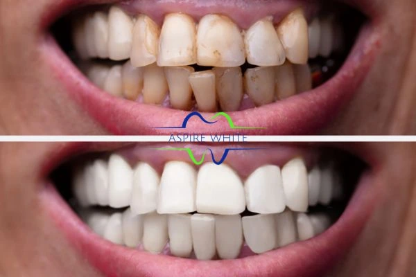 Before and after results of laser teeth whitening Burton upon Trent Book in online today!