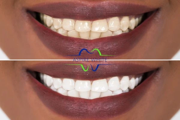 Side-by-side comparison showing before and after results of a cosmetic treatment Burton upon Trent