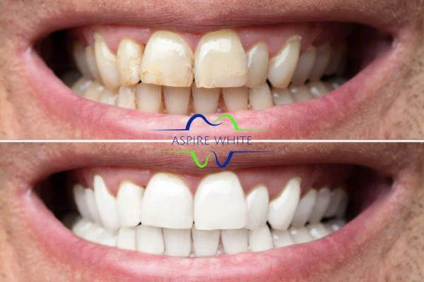 Achieve a radiant smile with professional laser teeth whitening Burton upon Trent